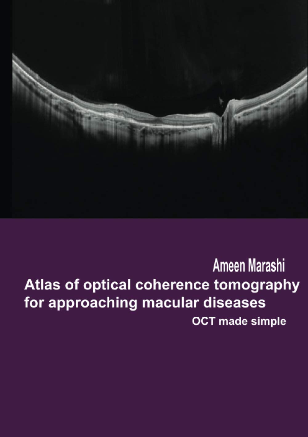 Atlas of optical coherence tomography for approaching macular diseases ...